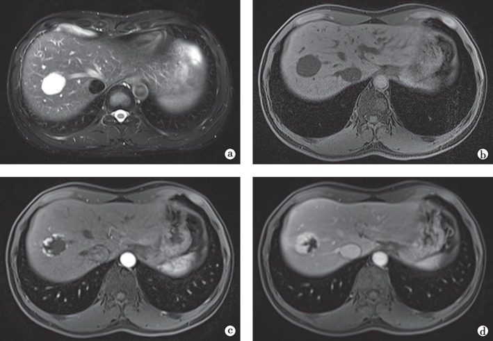 教材原图：肝海绵状血管瘤MRI，T2WI灯泡征，增强后周边结节样强化并逐渐向中心填充