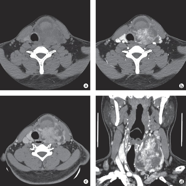 甲状腺乳头状癌 CT 表现