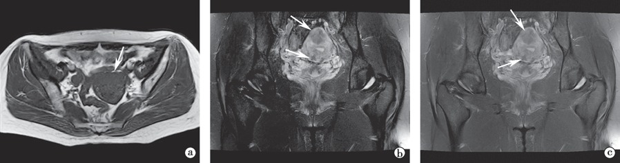 教材原图：多发子宫肌瘤MRI，子宫体壁内可见多发低信号结节