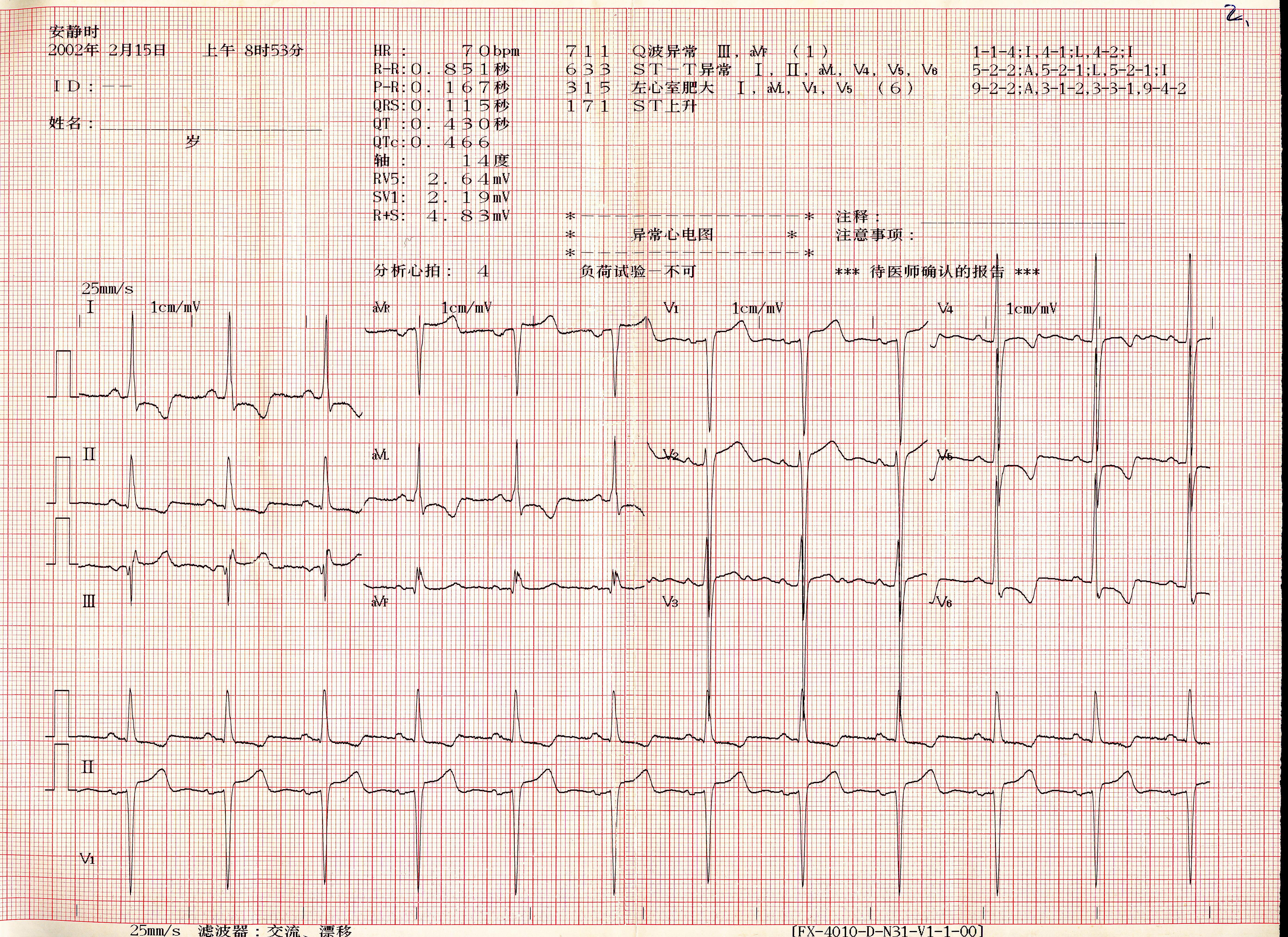 急性下壁STEMI