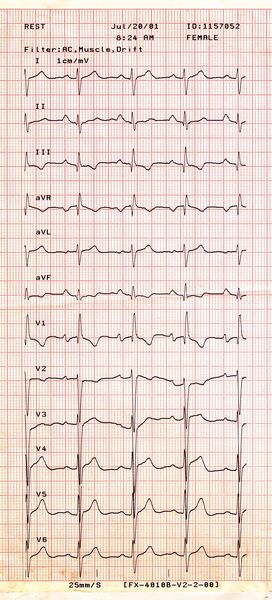 急性广泛前壁STEMI