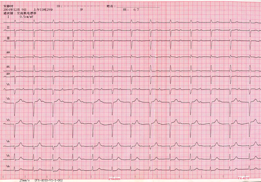 急性前间壁STEMI